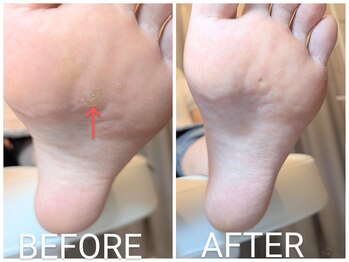 リヴィエール(Riviere)/20代女性　魚の目の違和感