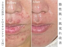 ゼアー(THERE FY.)/くり返す大人ニキビにVOS