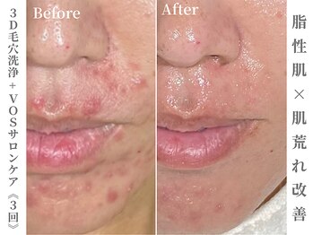 ゼアー(THERE FY.)/くり返す大人ニキビにVOS