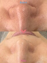 アレイズ(ARAYS)/症例(毛穴)