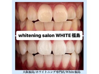 ホワイトニングサロン ホワイト(WHITE)/セルフホワイトニング/大阪/福島