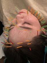 ジェイペック鍼灸整骨院/温熱ドーム＋美容鍼【浮腫撃退】