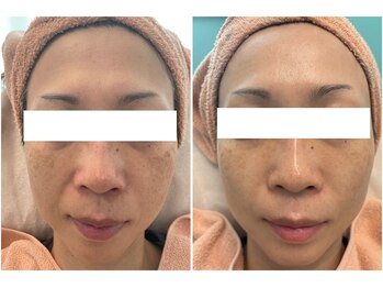 リッツ 所沢店/【Before/After】シミ改善