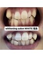 ホワイトニングサロン ホワイト(WHITE)&nbsp;【大阪/梅田/ホワイトニング/セルフホワイトニング/ブライダル】