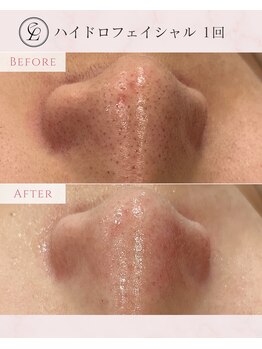 エンルーチェ(en;Luce)/ハイドロフェイシャル　1回目