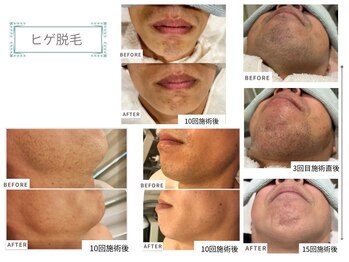 ベルスタイル(Bell style)/当店のお客様症例(ヒゲ脱毛)