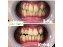 ルブラン 奈良店(Le Blanc)/通常15000円→13000円に！