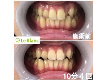 ルブラン 奈良店(Le Blanc)/通常15000円→13000円に！