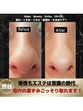 ココ センガ ビューティー クリニック(COCO SENGA Beauty-Clinic)/頑固な毛穴汚れもスッキリ！