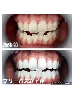 ホワイトニングサロン 京都烏丸店/ホワイトニングサロン 施術例