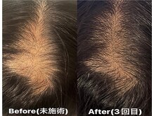 ヘッドサイエンス(HEADSCIENCE)の雰囲気（育毛促進鍼は数回でもこの効果!【男女共】にご実感頂いてます◎）