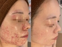 エスアール アミティ(SR Amity)/左Before／右After 