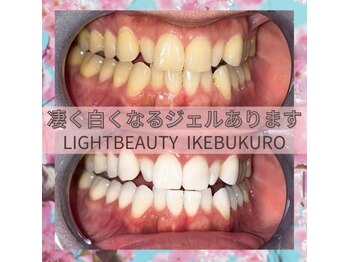 ライトビューティー 池袋店(LightBeauty)/症例写真