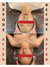 ハレアンド(Hare&)/小顔ハイパーナイフコルギ