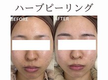 ティアム バイ テトテ 神戸三宮(TIAM by tetote)/ハーブピーリング