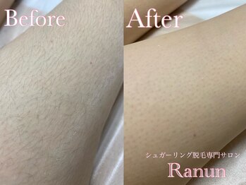 ラナン(Ranun)/角質も同時にオフできる脱毛法