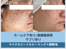 アロマ(AROMA)/凹凸跡/毛穴/越谷せんげん台