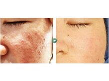 ハルリ(Haruri)の雰囲気（毛穴ケアやニキビケアで肌質改善を目指します）