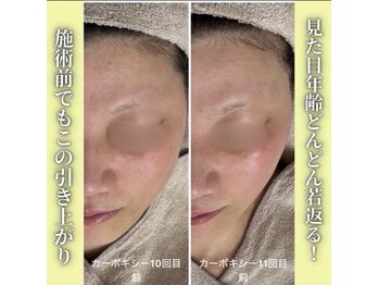 ハニエル(Haniel)/カーボキシー症例