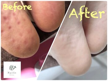 ネイリット 銀座(Nailit)/乾燥対策【SpaLuce】角質ケア