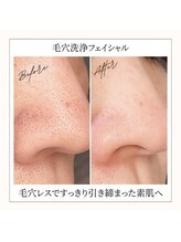 イリゼ(iriser)/毛穴洗浄ハイドロBeforeAfter