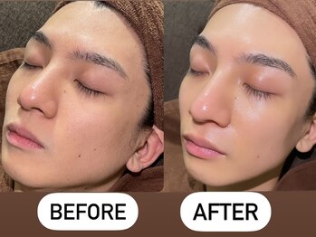 ソーレエルーナ(SOLE e LUNA)/脱毛 毛穴 メンズ脱毛 毛穴洗浄