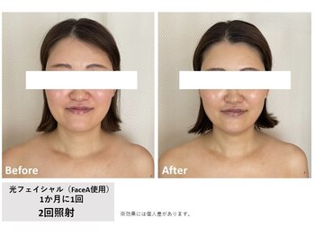 メイ(meiy)/たるみ/しわ/美白/毛穴