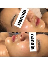 ナナラ(nanala)/韓国水光肌フルコースエステ