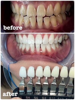 エクシア ホワイトニング 富山店/ビフォーアフター写真☆