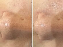 ケアナ 梅田店(CareNa)/ツヤ肌毛穴洗浄★ヒト由来幹細胞