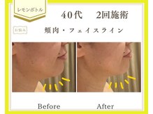 リュミエール(Lumiere)/【症例】レモンボトル脂肪燃焼