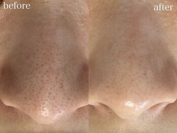 ホワイトアクア 梅田本店(WHITE AQUA)/ハーブピーリング/毛穴洗浄/梅田