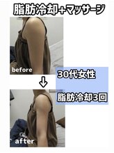 シャルム(CHARME)/脂肪冷却