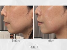 メルト 中目黒(Melt.)/◇ララ×サーマ×導入