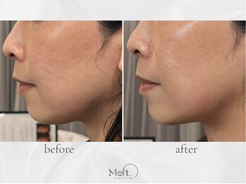 メルト 中目黒(Melt.)/◇ララ×サーマ×導入