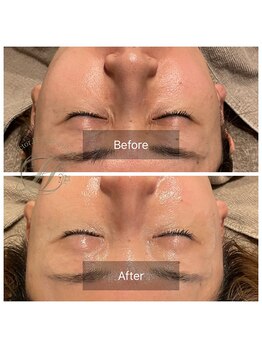 ドクターエイチ 麻布十番店(Doctor.H)/目元の詰まり、しわケア