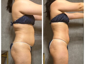 フュース(Futh)/セルライトケア◇途中経過