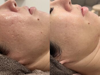 シュリー(Sriii)/エンビロン乳酸×イオン導入3回