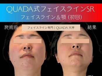 マイスター整体院 天神院の写真/【西鉄天神駅/天神南駅から徒歩3分 21時迄】当院オリジナルQUADA式フェイスラインSRで当日から小顔に♪
