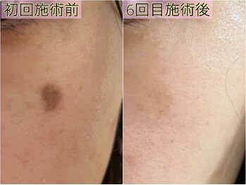 コルザフラワー(charroux flower)の写真/夏のダメージ！早めに撃退！