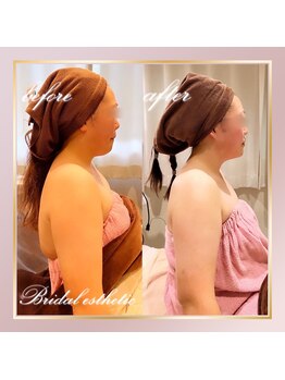 デジール(DESIR)/【小顔×ラジオ波フェイシャル】