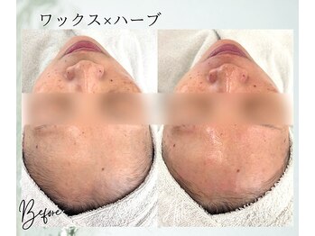 ポノ 茅ヶ崎(Pono.)/茅ケ崎/湘南/脱毛/毛穴/ハーブ