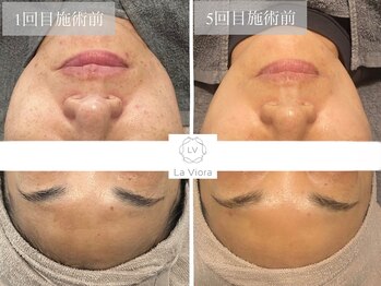 ラヴィオーラ 西宮北口店(La Viora)/ダイヤモンドハーブピーリング