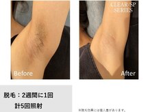 レア(Le'a)/【わき脱毛】