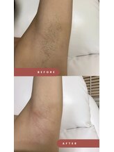 ワンダー(Wonder)/脱毛だけじゃない！黒ずみもOFF