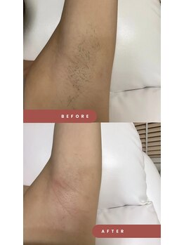 ワンダー(Wonder)/脱毛だけじゃない!黒ずみもOFF