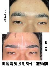 レオナルド(Leonardo)/美容電気脱毛眉毛