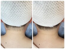 エクボ(EcBeau)/うなじ脱毛といえばエクボ