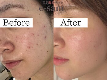 イーサム(e-sam)/光フェイシャル＆炭酸パック