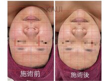 カウイ(KAUI)/KAUIの No.1人気【小顔×美肌】